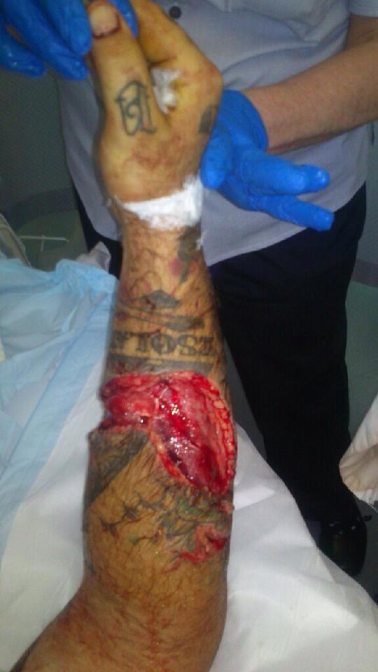 "He could have bled out, we nearly lost him"