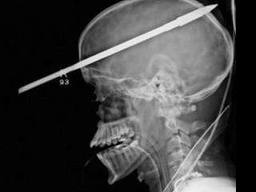 Spear Successfully Removed from Teen's Head